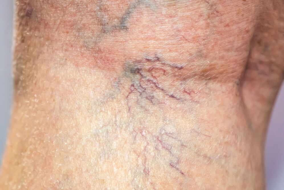 Varices sur le corps