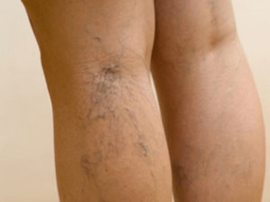 La deuxième étape des varices
