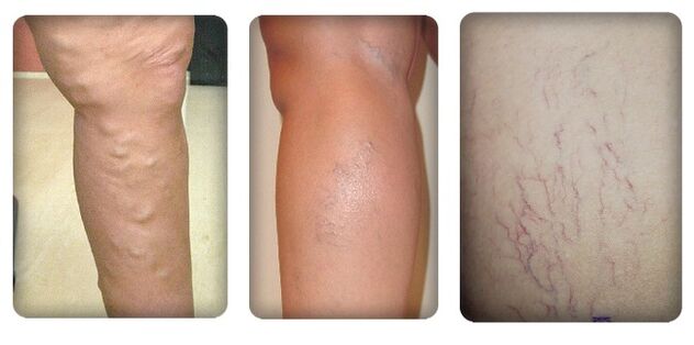 Stades de varices