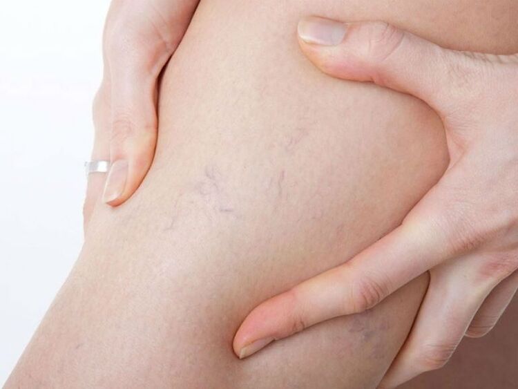 Varices sur les jambes