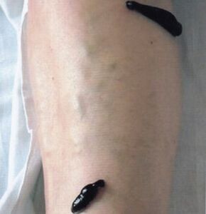 Hirudothérapie comme méthode pour traiter les varices