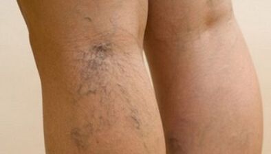 Les causes des varices