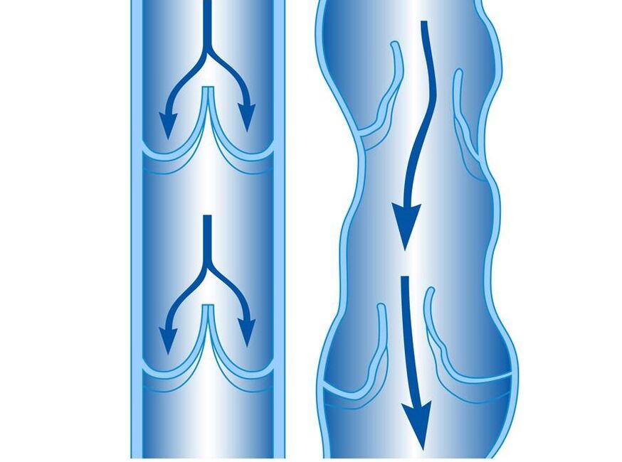 veines saines et varices