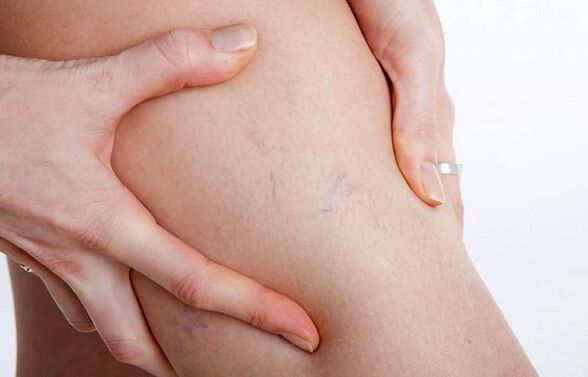 Douleur aux jambes due aux varices