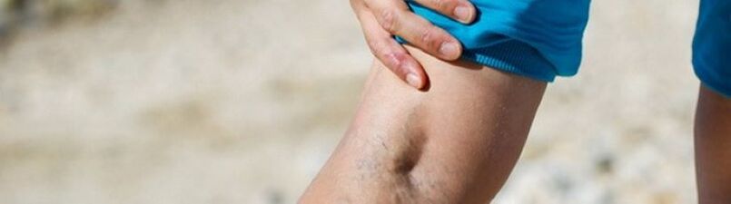 Varices sur les jambes