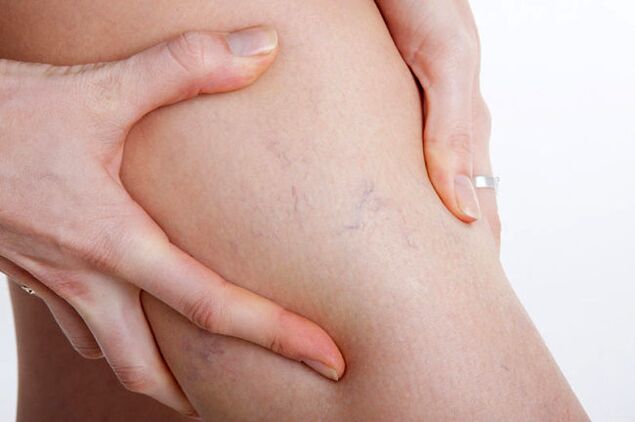 La première apparition de varices sur la jambe