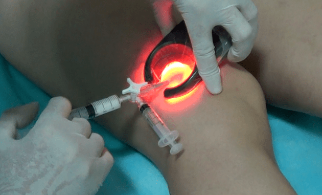 La sclérothérapie est une méthode efficace pour traiter les varices des jambes
