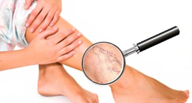 Varices sur les jambes