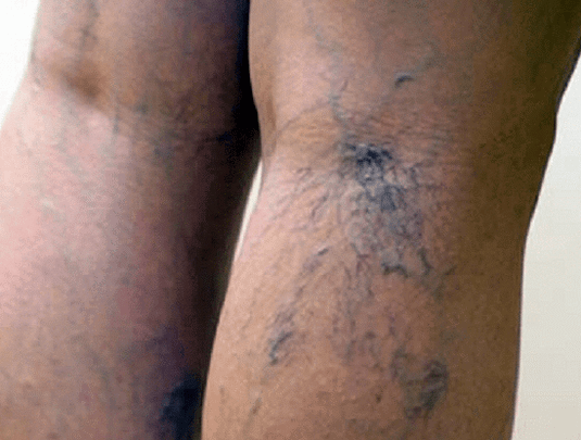 Varices sur les jambes